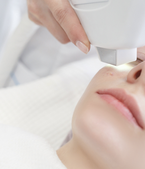 laser-acne2