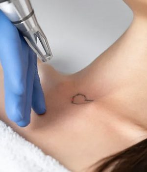 laser-tatuagem