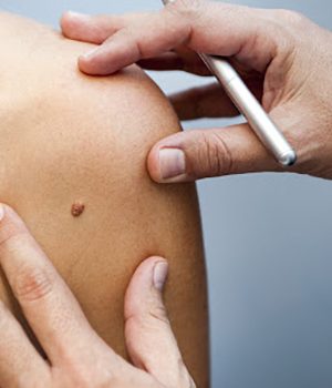 A medical consultation at the Removal of nevus.
